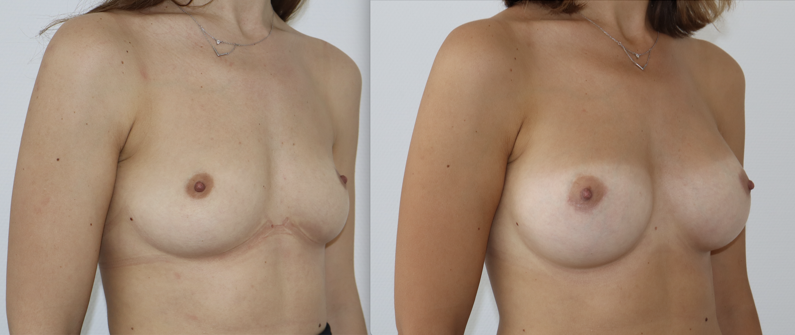 Avant/Après prothèses mammaires